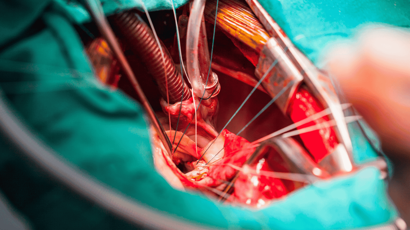 Advanced Heart Valve Procedure Gains Momentum in Nagpur